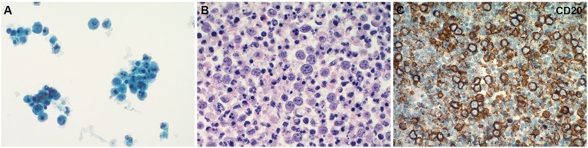 The application of the International System for Reporting Serous Fluid Cytopathology may help to better categorize pericardial fluid and facilitate the standardization of cytopathology reporting.

🔗 acsjournals.onlinelibrary.wiley.com/doi/10.1002/cn…

#CytoPath