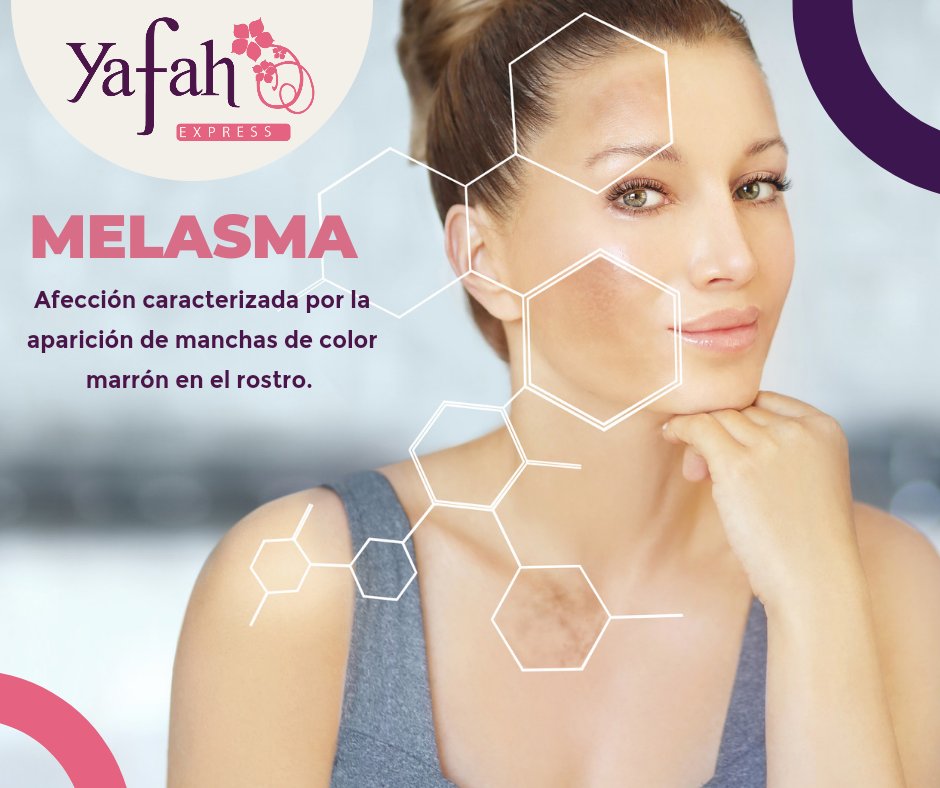 AguascalYafah's tweet photo. ✔️El melasma es un tipo de hiperpigmentación corriente en mujeres, especialmente durante y después del embarazo. ✔️Aparece en forma de grandes manchas oscuras sobre la cara, aunque también pueden afectarse otras partes del cuerpo.#piel #manchas #rostro #Mujeres#yafahags https://t.co/AXQc9eMV7r