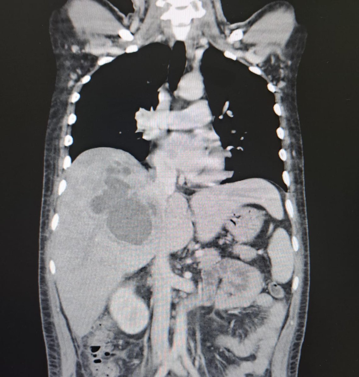 HEP_Zona4's tweet photo. Mediante guía ecográfica se realizó drenaje percutáneo a paciente con diagnóstico de gran absceso hepático de difícil abordaje por cirugía abierta, logrando mejoría clínica inmediata de la condición del paciente. https://t.co/UZAy1Ki1tl