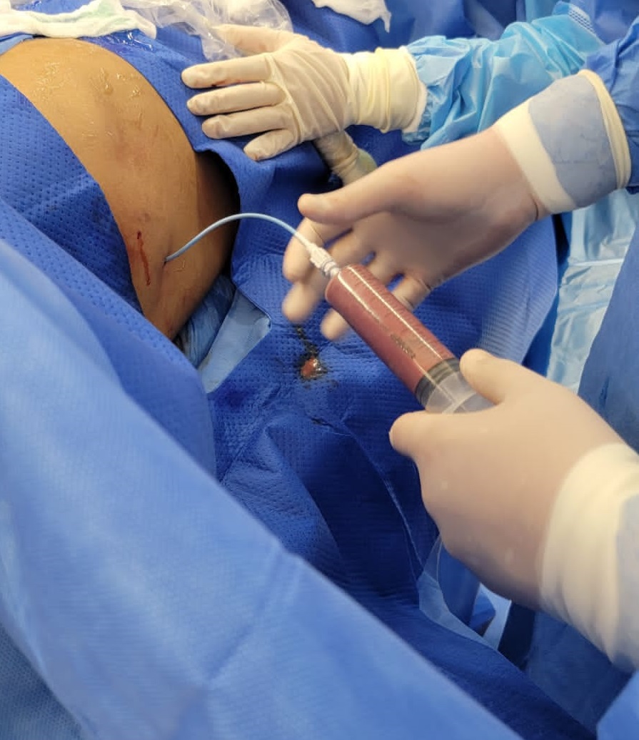 HEP_Zona4's tweet photo. Mediante guía ecográfica se realizó drenaje percutáneo a paciente con diagnóstico de gran absceso hepático de difícil abordaje por cirugía abierta, logrando mejoría clínica inmediata de la condición del paciente. https://t.co/UZAy1Ki1tl