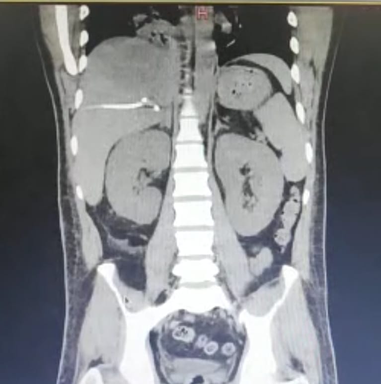 HEP_Zona4's tweet photo. Mediante guía ecográfica se realizó drenaje percutáneo a paciente con diagnóstico de gran absceso hepático de difícil abordaje por cirugía abierta, logrando mejoría clínica inmediata de la condición del paciente. https://t.co/UZAy1Ki1tl