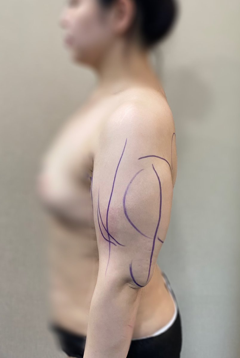 kaajimoon's tweet photo. エッジラインさんで二の腕脂肪吸引！
術前と２週間後。人間の腕になれて幸せ！
チョン院長ありがとうございます✨
スタッフの皆さん対応が良かったです
通訳さんが最高でした☺️🤍
下腹の再手術と下半身もお願いしたい🙏🏻

@edgeline_jpkr https://t.co/41yXIyMw2a