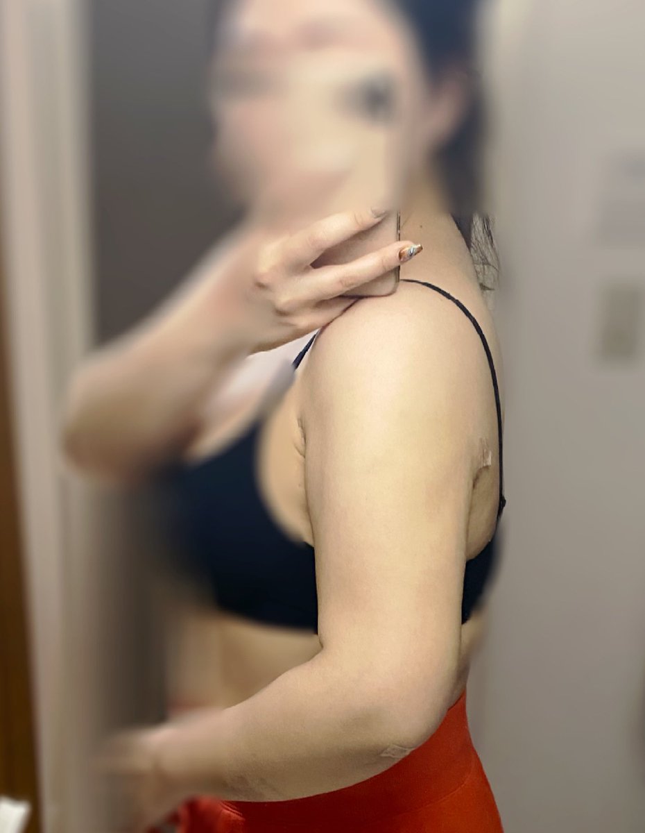 kaajimoon's tweet photo. エッジラインさんで二の腕脂肪吸引！
術前と２週間後。人間の腕になれて幸せ！
チョン院長ありがとうございます✨
スタッフの皆さん対応が良かったです
通訳さんが最高でした☺️🤍
下腹の再手術と下半身もお願いしたい🙏🏻

@edgeline_jpkr https://t.co/41yXIyMw2a
