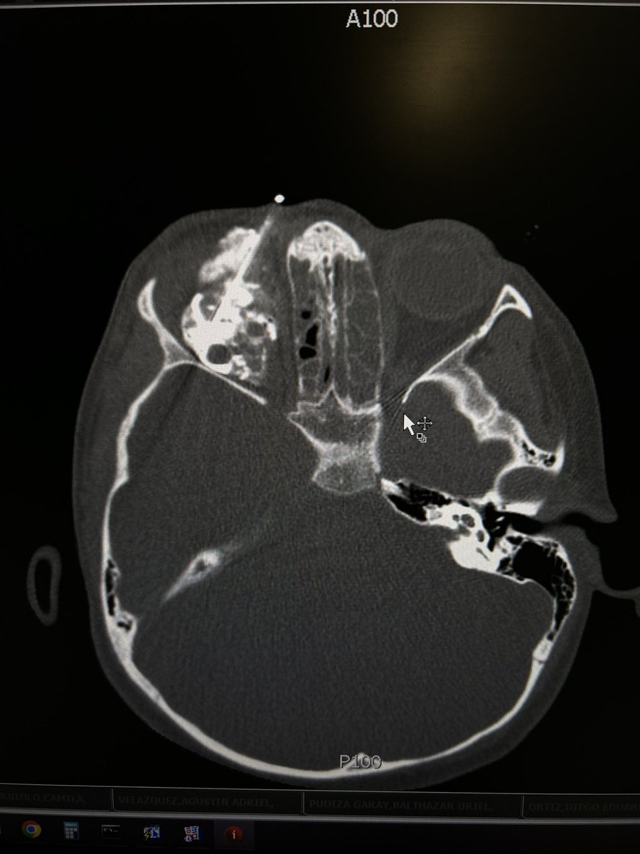 Dtepl's tweet photo. Retro-ocular vascular malformation, pain, and exophthalmos. CT-guided access. Contrast to confirm position and #sclero with Bleo (sometimes STS) Always should Be aware of the oculo-cardiac-reflex published by @BarnacleAlex in @CVIR_Journal https://t.co/wiqQTs31iq https://t.co/2n49V2QaWz