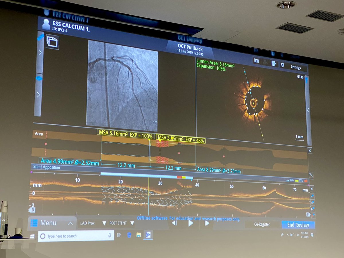 Shockwave Medical (@shockwaveivl) on Twitter photo High value #EuroPCR session on the importance of intravascular imaging to plan Ca++ approach. Great #CoronaryIVL case by Drs <a href="/ESHLOF/">Evan Shlofmitz</a> <a href="/ziadalinyc/">Ziad Ali</a> <a href="/DrNataliaP/">Natalia Pinilla</a> <a href="/KVM83/">Kalaivani Mahadevan</a> that used #OCT to decide on #ShockwaveC2 for lesion prep & had optimal stent expansion.
ISI bit.ly/3iEq7fC High value #EuroPCR session on the importance of intravascular imaging to plan Ca++ approach. Great #CoronaryIVL case by Drs <a href="/ESHLOF/">Evan Shlofmitz</a> <a href="/ziadalinyc/">Ziad Ali</a> <a href="/DrNataliaP/">Natalia Pinilla</a> <a href="/KVM83/">Kalaivani Mahadevan</a> that used #OCT to decide on #ShockwaveC2 for lesion prep & had optimal stent expansion.
ISI bit.ly/3iEq7fC