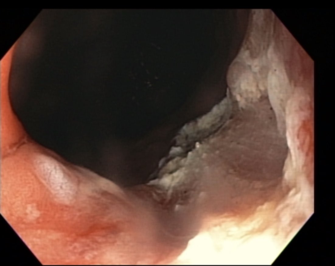 A. Samad Soudagar (@soudagargimd) on Twitter photo OSH referral for 10 mm esophageal nodule w BE and HGD. Resected successfully via band EMR-great margins. Continuing the therapeutic interventions discussed by the BE Committee at the <a href="/FITE_endoscopy/">FITE - Foundation</a> fellows event at #DDW2023!! #GITwitter OSH referral for 10 mm esophageal nodule w BE and HGD. Resected successfully via band EMR-great margins. Continuing the therapeutic interventions discussed by the BE Committee at the <a href="/FITE_endoscopy/">FITE - Foundation</a> fellows event at #DDW2023!! #GITwitter