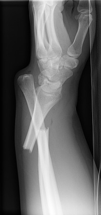 Q. What are the deforming forces on the distal radius segment in Galeazzi fractures? #orthotwitter