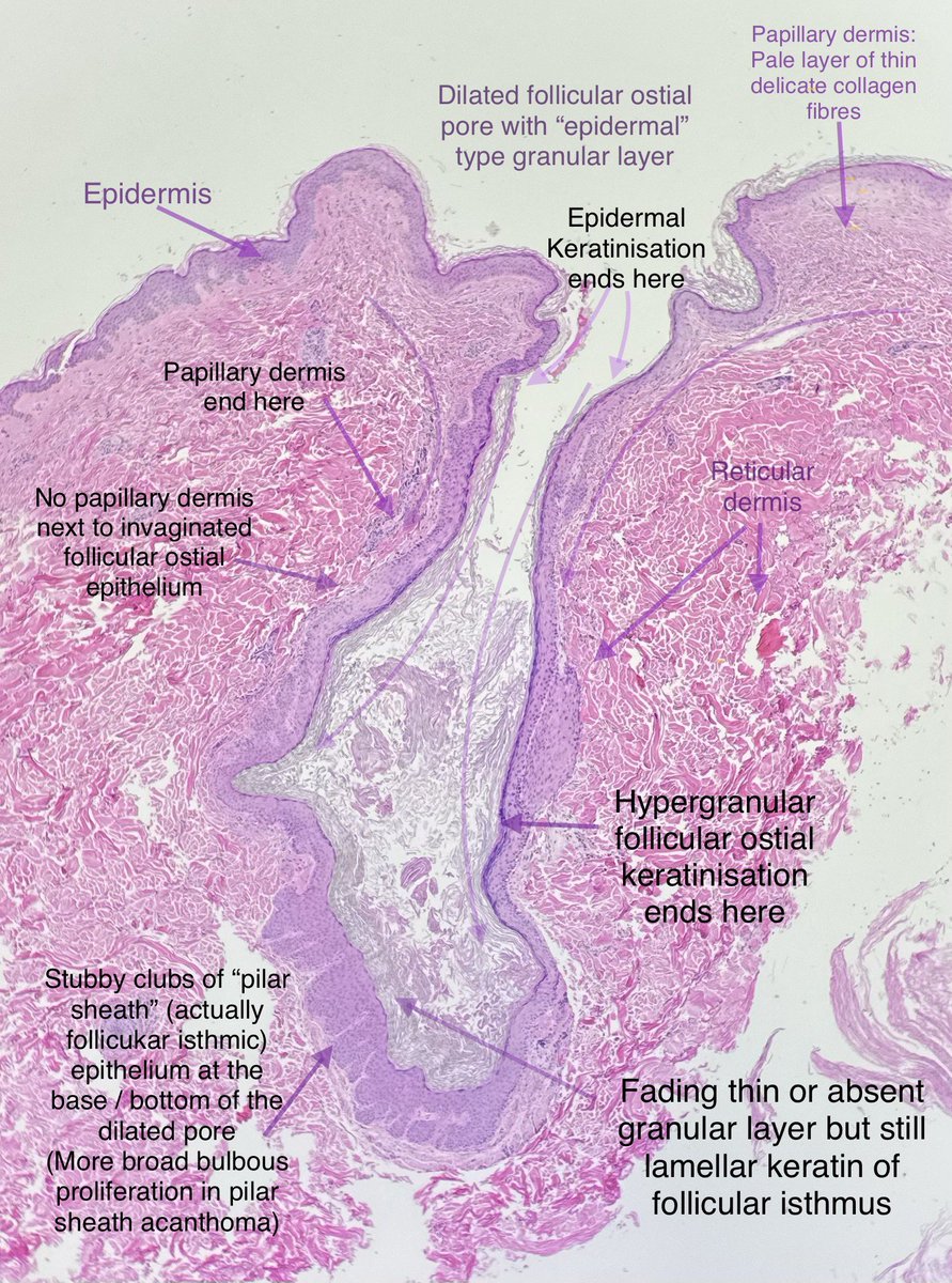 The fine structure of a Dilated Pore of Winer. 

#dermpath #dermtwitter #pathtwitter #pathresident #dermatologia #dermatology  #dermatologist #pathologist #histopathology #surgpath #dermatopathologia #dermatopathology