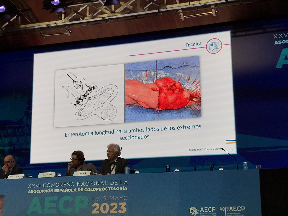 Anastomosis S-Kono por el @delaportillaMD #AECP2023