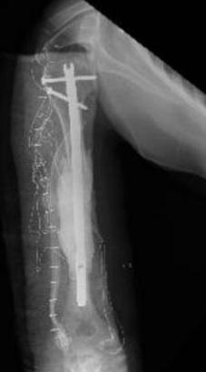 64y/o F. Metastatic Adenoca.

#bghmc 
#metastasis 
#mirels
#orthoonco