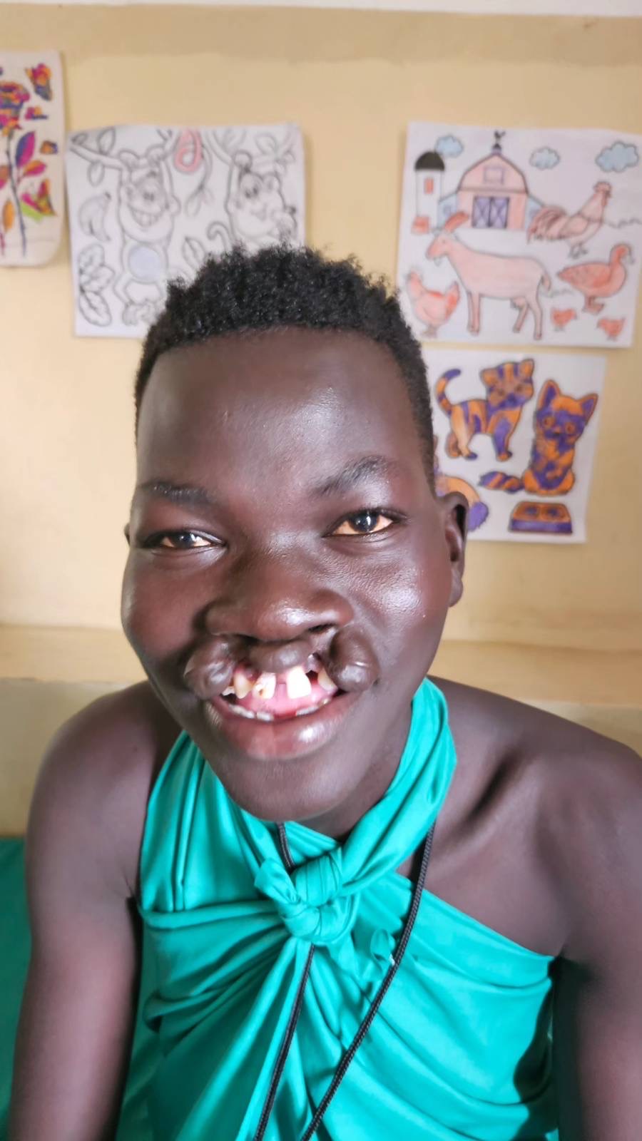 Samaritan's Purse on X: "Last month, Thomas made the long journey from his  home in Tonj to Juba, South Sudan to receive life-changing cleft palate  surgery from our team. With his newly