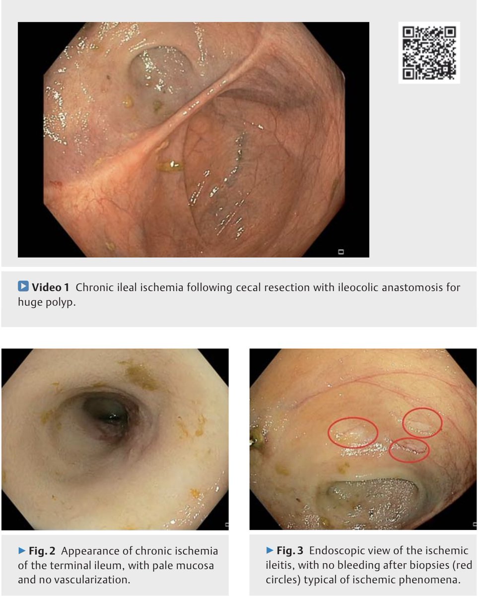 drkeithsiau's tweet photo. If you see a white and featureless terminal ileum, especially after surgery, think of chronic ischaemic ileitis. Management = surgical resection and formation of a new anastomosis 💡

https://t.co/2UukfuXxHm https://t.co/DKTlltC2yl