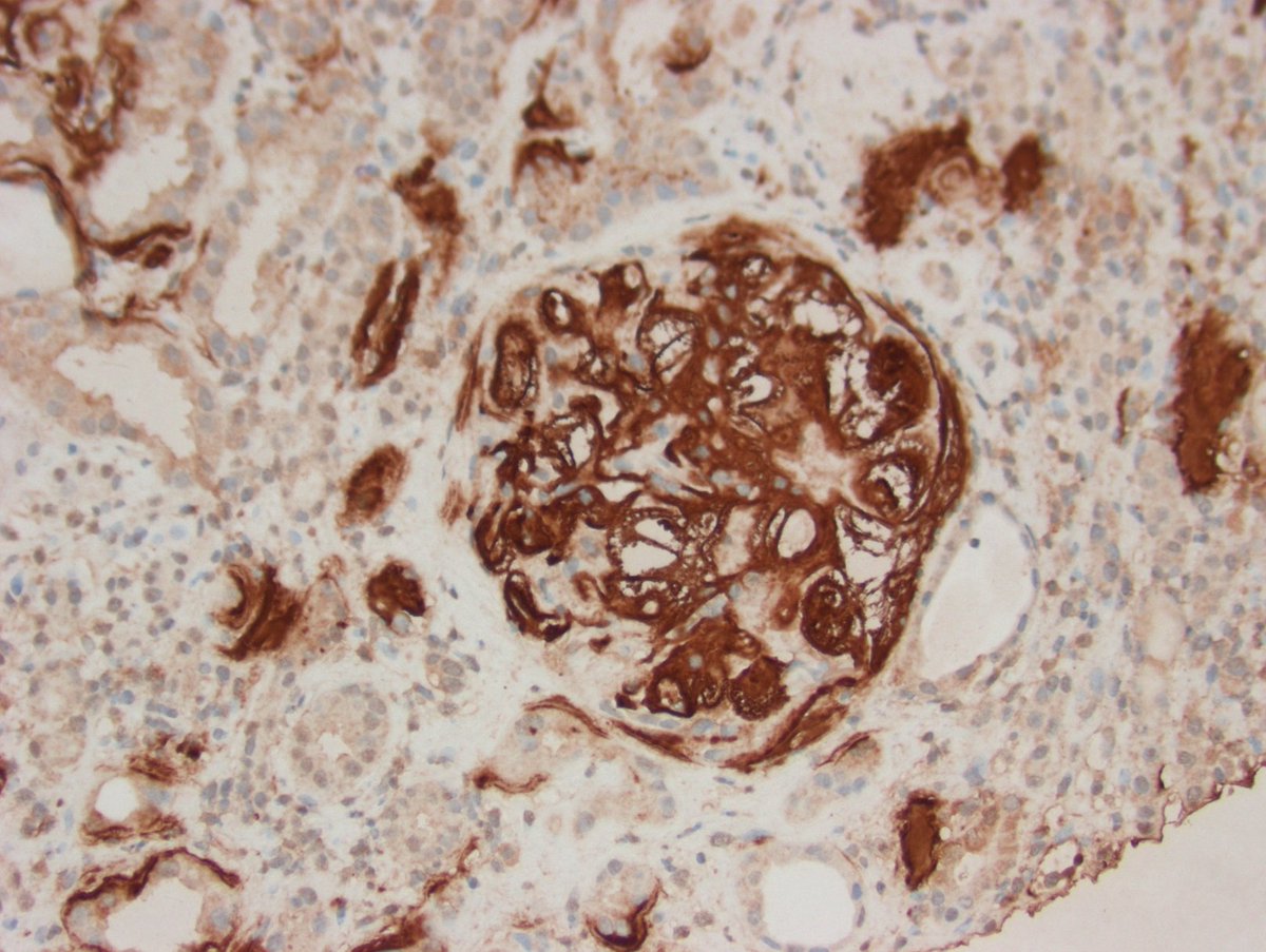 AA-amyloid due to IV drug use. We get a good number of these in Northern California, but prevalence depends on location. Possibly related to type of heroin (black tar in particular). #RenalPath