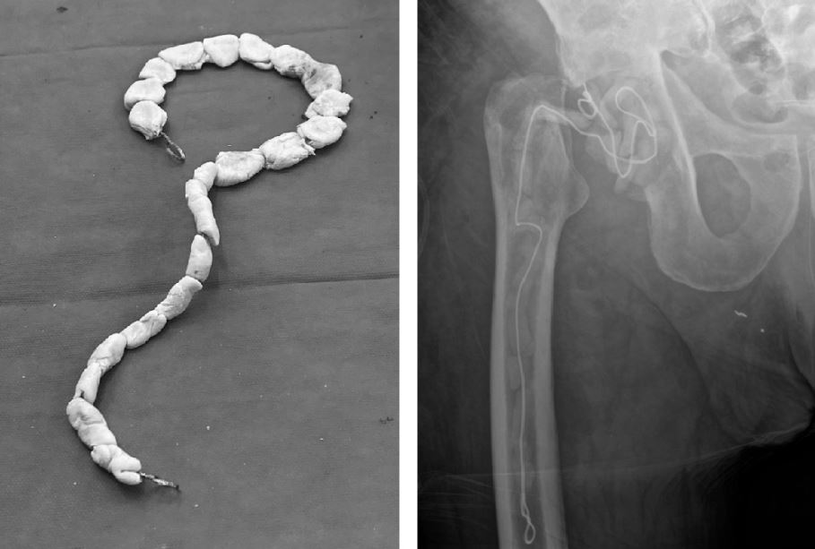 The Bone & Joint Journal (@bonejointj) on Twitter photo Aggressive surgical debridement & high-dose, targeted antibiotic cement beads at time of first-stage surgery, without use of prolonged systemic antibiotics, has a high rate of success.
#Hip #BJJ @mikepetrie4 <a href="/Sunil_Panchani/">Sunil Panchani</a> <a href="/InfectionDave/">Dave Partridge</a> <a href="/CavendishHip/">Cavendish Arthroplasty Fellowship</a>
ow.ly/22pH50OcFwk Aggressive surgical debridement & high-dose, targeted antibiotic cement beads at time of first-stage surgery, without use of prolonged systemic antibiotics, has a high rate of success.
#Hip #BJJ @mikepetrie4 <a href="/Sunil_Panchani/">Sunil Panchani</a> <a href="/InfectionDave/">Dave Partridge</a> <a href="/CavendishHip/">Cavendish Arthroplasty Fellowship</a>
ow.ly/22pH50OcFwk