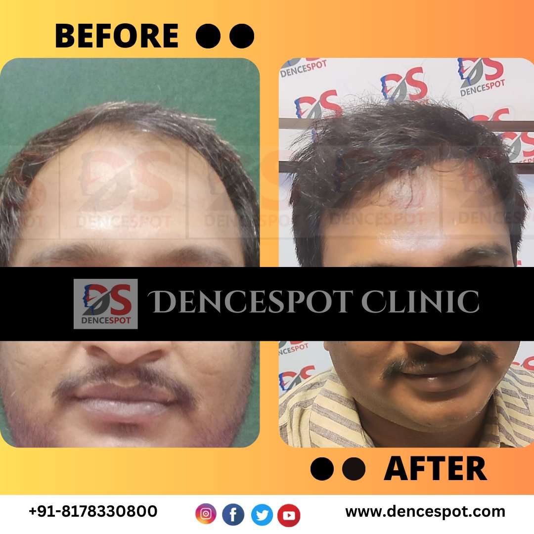 DenceSpot's tweet photo. Enjoy Your Natural Hair By FUE Hair Transplant at #dencespotclinicgurugram
Call For Free Consultation
8178330800
Visit : https://t.co/nyTffjEpVL
#hairtransplantresults #hairtransplant #hairtransplantation #hairtransplantsurgery #hairloss #hairtransplantturkey https://t.co/uXUX80DeDw