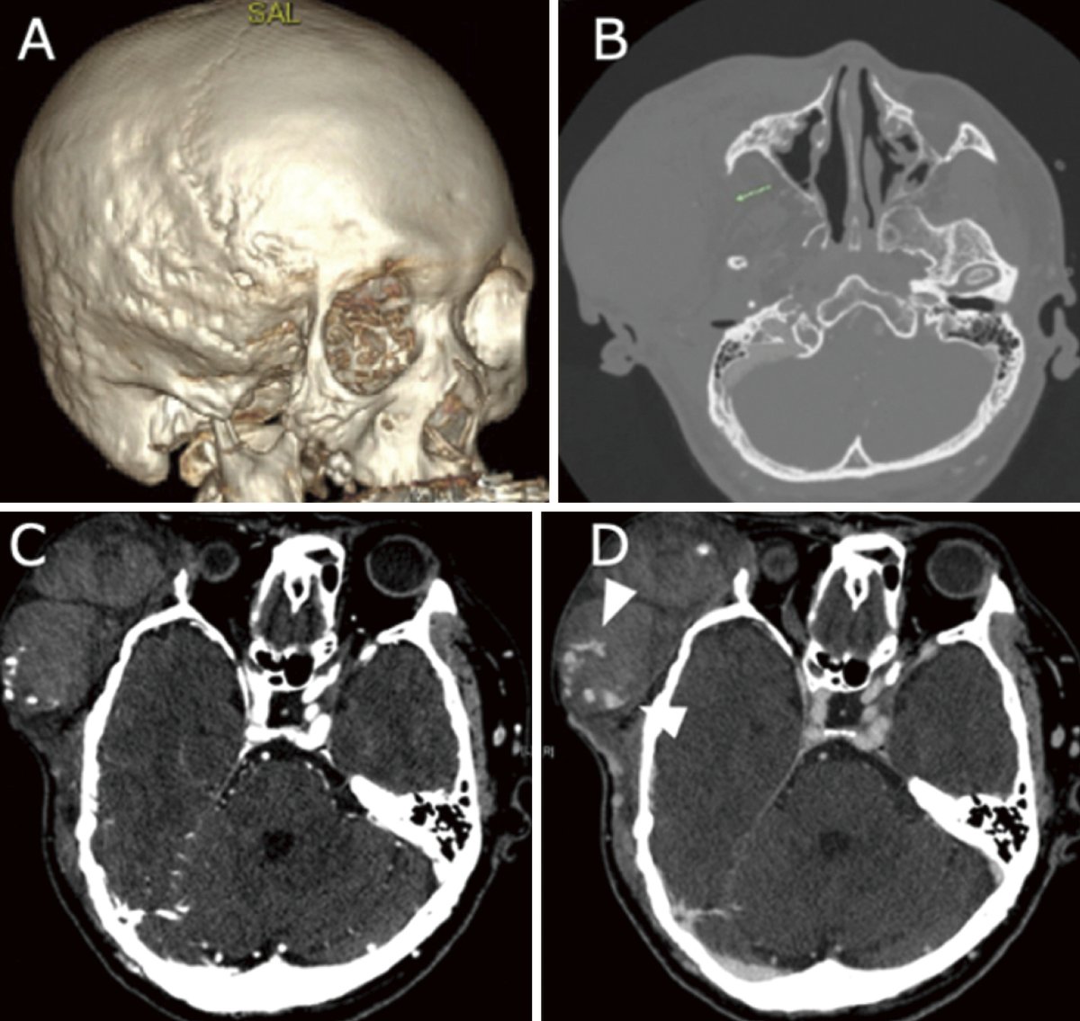 'New Arrival: A Case of Neurofibromatosis Type 1 Diagnosed after Idiopathic Rupture of Superficial Temporal Artery Pseudoaneurysm Requiring Endovascular Treatment
doi.org/10.2176/jns-nm…
#Neuroivr #NeurofibromatosisType1 #IdiopathicSuperficialTemporalArteryPseudoaneurysm