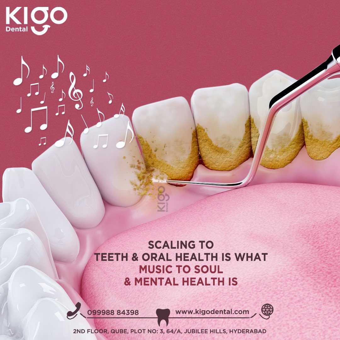 Those periodic cleanings work like magic for your oral and overall health.

website: kigodental.com
#kigodental #kigo #dental #hyderabad #jubileehills #kavurihills #madhapur #madhapurhyderabad #cyberabad #periodontia #periodoncia #periodontoloji #periodontista #periodon