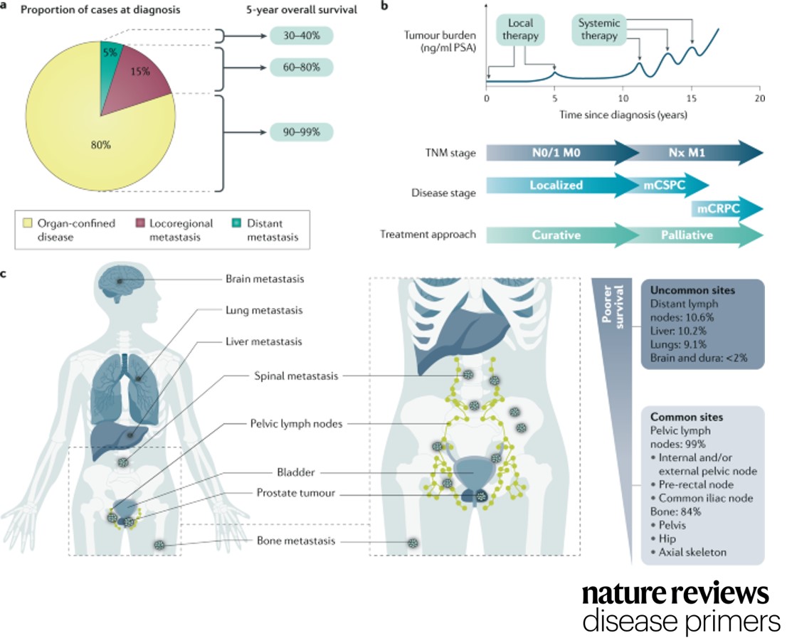 Nature Reviews Disease Primers on Twitter: "Most prostate #cancers at
