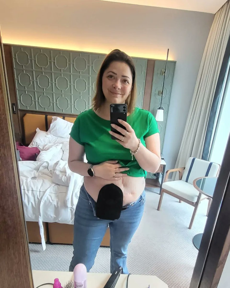 Pelican Healthcare (@pelicanhealth) on Twitter photo "Waking up after 3 weeks on life support and seeing a rather large open wound, wires every where and a new stoma that I was not expecting can have a dramatic down turn of ones mental health." <a href="/crohnsfighting/">crohns fighting</a> π
Read more π buff.ly/3OjbSgh "Waking up after 3 weeks on life support and seeing a rather large open wound, wires every where and a new stoma that I was not expecting can have a dramatic down turn of ones mental health." <a href="/crohnsfighting/">crohns fighting</a> π
Read more π buff.ly/3OjbSgh