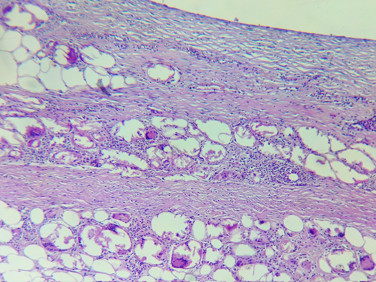 kr_abhisek's tweet photo. #PathTwitter A Hemorrhagic cyst in breast of  a  64/f. For your valuable opinion on pathophysiology @pepeffernan @TogyTtzach13 @nusrat_xahra @Venkateshgilly2 @SumantaDas_7 @AnupamaArya12 @Divya_Madhala @DRJSSURI @padmapathology1 @archibhat3 @marquess_raj @pkmadridista @vi_monappa https://t.co/d4JqTMtQvk