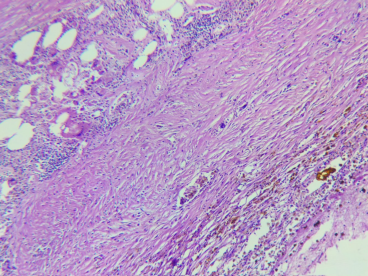 kr_abhisek's tweet photo. #PathTwitter A Hemorrhagic cyst in breast of  a  64/f. For your valuable opinion on pathophysiology @pepeffernan @TogyTtzach13 @nusrat_xahra @Venkateshgilly2 @SumantaDas_7 @AnupamaArya12 @Divya_Madhala @DRJSSURI @padmapathology1 @archibhat3 @marquess_raj @pkmadridista @vi_monappa https://t.co/d4JqTMtQvk