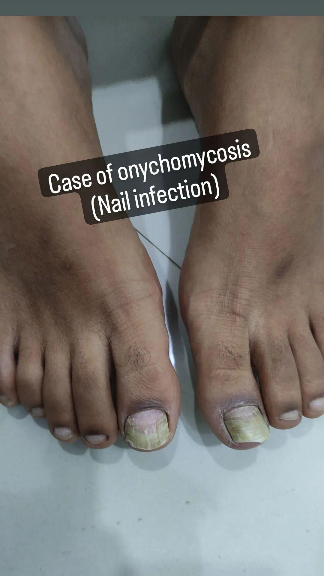 Fungal Infections Cause, Symptoms and Ayurvedic Treatments - Dr. Sharda  Ayurveda