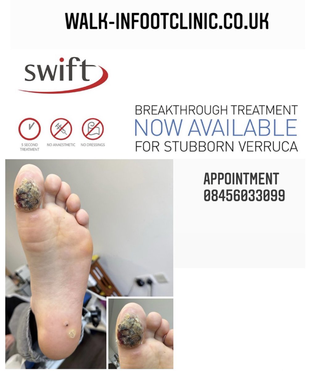 Walk_In_FC's tweet image. #walkinfootclinic#iamnotfamousbutfamouspeopleknowme#GaitAnalysis#Orthotics
#knightsbridge#kensington#chelsea#luxury#instagrammer#swiftmicrowavetherapy #wemakewaves #swiftcommunity #innovativetechnology 
#privatepractice#verruca#swiftmicrowave