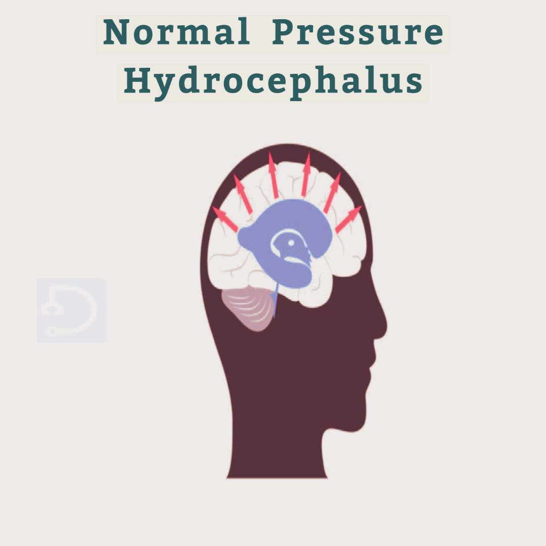 Normal Pressure Hydrocephalus affects the brain's ability to function optimally.

Click here 🔗bit.ly/3MAzOuu to learn more about Normal Pressure Hydrocephalus

#NormalPressureHydrocephalus #NPH #NPHAwareness #MedEd #Docsteth #NeurologicalHealth #HealthJourney