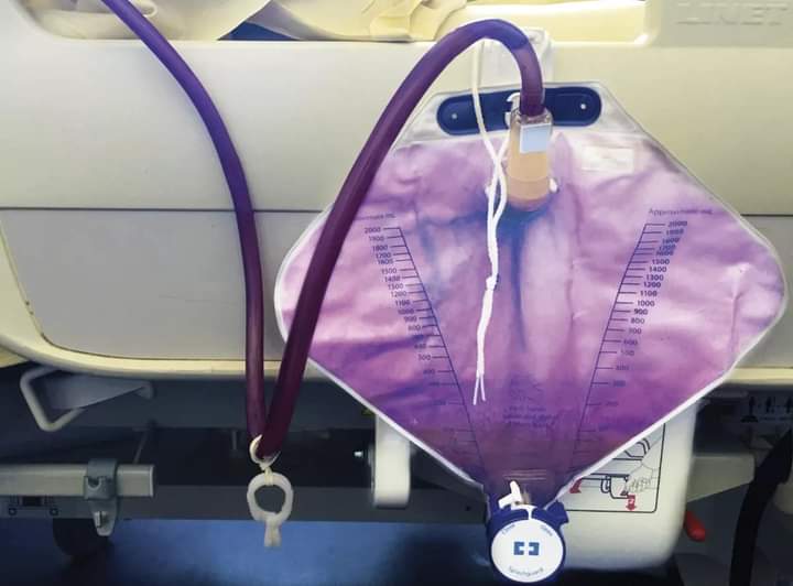 🟣Purple handbag :-P
You observe that a patient's urine has turned purple as shown in the image. What are the possible causes?
#MedTwitter #medicine #Purple #medicalstudents #MedEd #ClinicalPearl #spotdiagnosis #urology