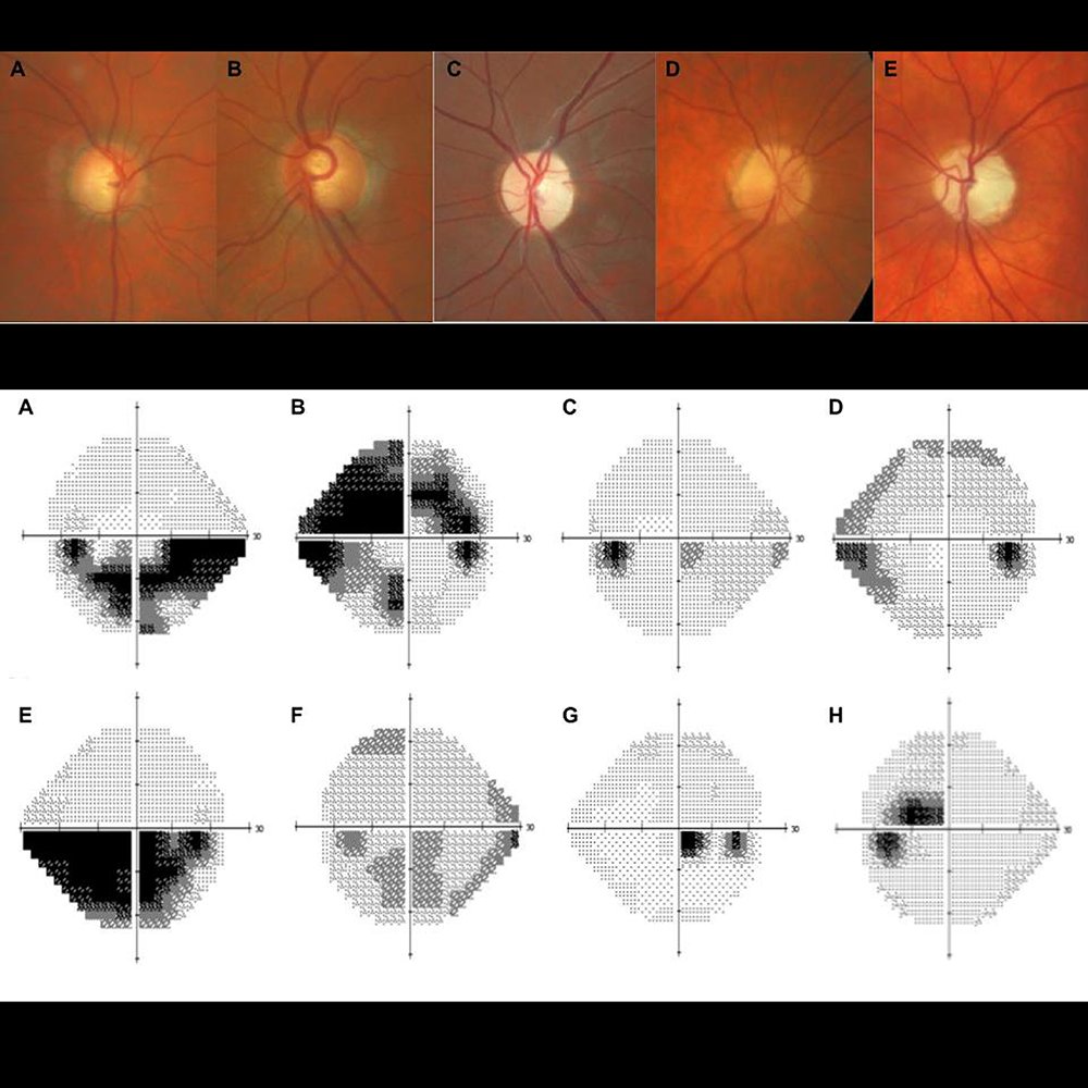 Nonglaucomatous optic neuropathy (NGON) is often mistaken for normal-tension glaucoma. This study reports on the characteristics of patients referred for neuro-ophthalmologic consultation to distinguish between glaucomatous optic neuropathy and NGON.
bit.ly/cjo_patients-q…