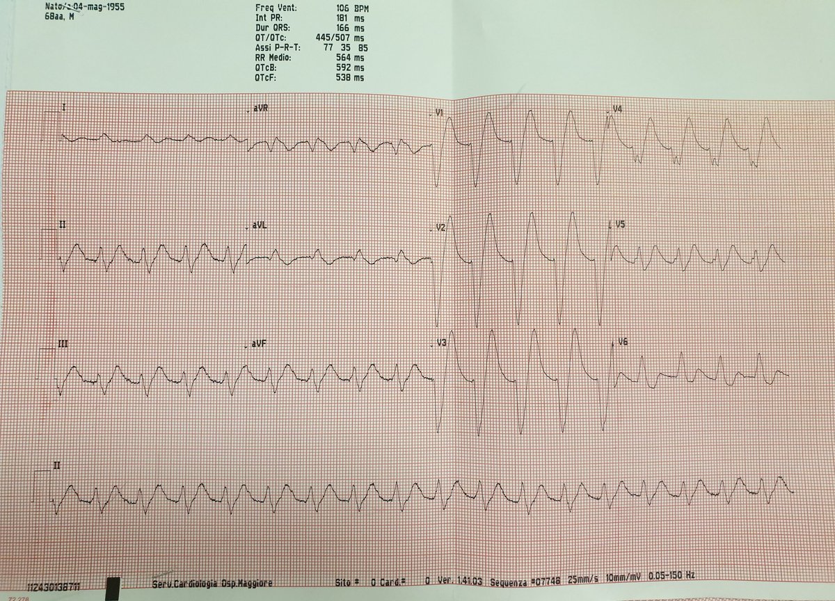 50yo
Past history of AF, in therapy with propafenone (pill in the pocket)
Stable. Symptomatic for palpitations.
Any thoughts?🤔