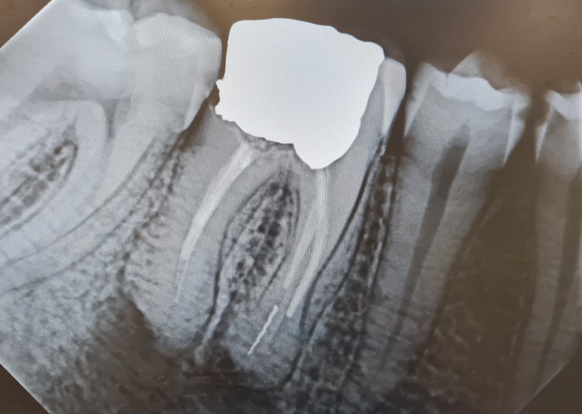 #حالة اليوم خلع للسن الطاحن الخلفي الاول 🦷

تم خلعه بنجاح ولله الحمد 🦷 
Extraction of tooth nu.46 
#OMFS #surgery #dental_surgery #surgen #dental_surgery