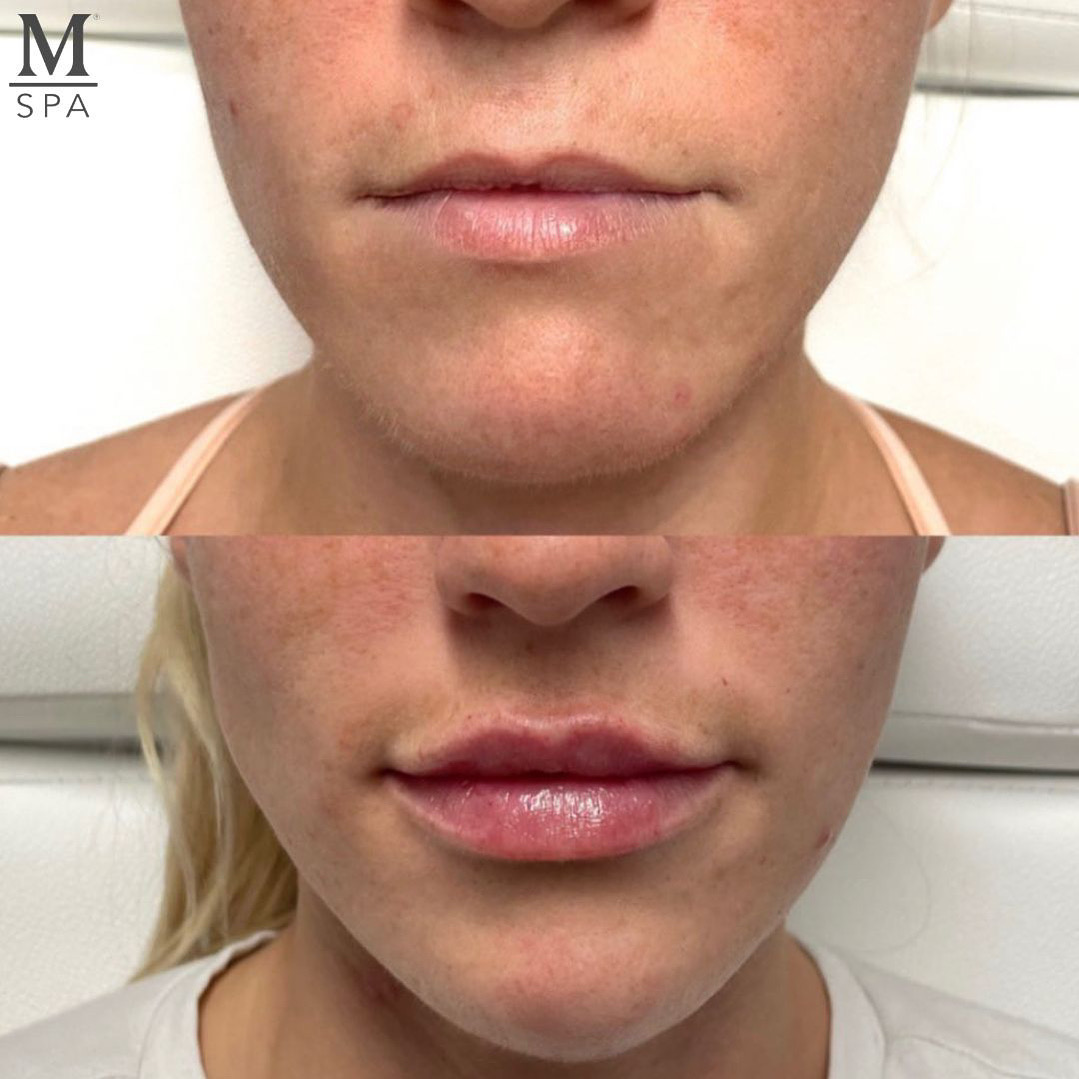 Perfectly sculpted lips for our beautiful patient 👄 She received