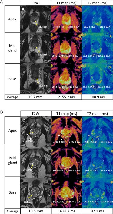 lkayat's tweet image. Happy to share our new publication at @EJR_official_   describing the quantitative T1 and T2 values of the normal-appearing peripheral zone of the #prostate, based on MR fingerprinting. Huge thanks to co-authors @eduardotcorreia @mrimark @QiaoMDPhD and Yong Chen!  (1/2)