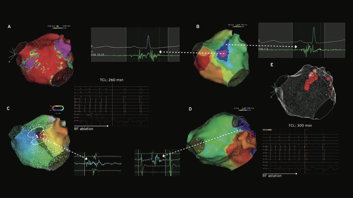 Functional Substrate Mapping Under Sinus Rhythm Predicts Critical Isthmus of Atrial Tachycardia @hikmetyorgun and colleagues describe 3 cases of FSM characteristics and their relation to critical isthmus of reentrant atrial tachycardias. okt.to/swf9VJ