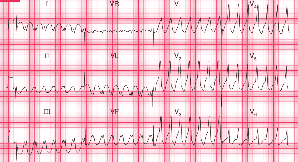 ManualOMedicine's tweet photo. A 60 y.o. man with severe central chest pain, a few minutes later he became extremely breathless and collapsed. 
- What's your interpretation and what would you do?  

➡️ Answer and Interpretation: https://t.co/kXIJizpRwl

#medtwitter #foamed #CardioEd https://t.co/m38jXYV0pV