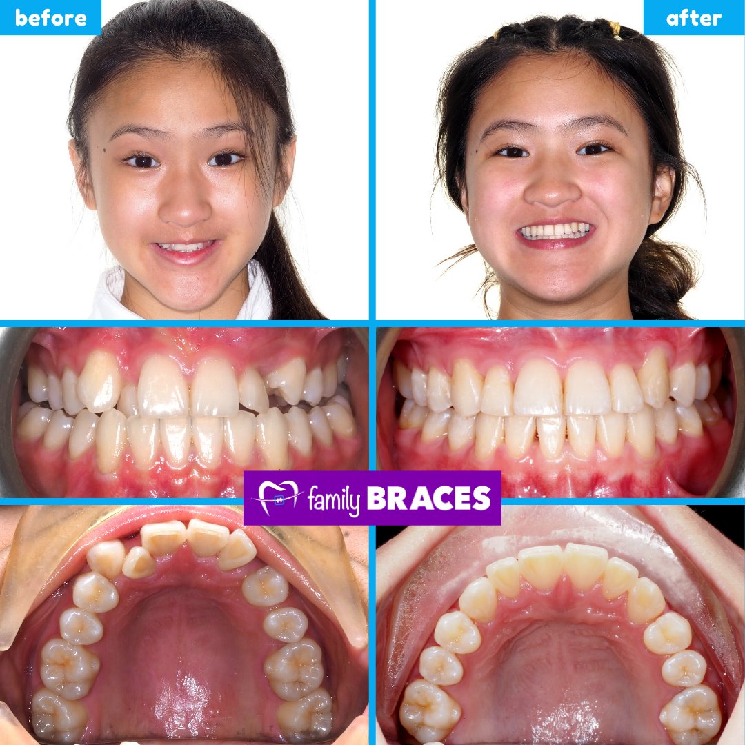 family_braces's tweet photo. 😢 Problem: Minimal Overbite, Single Tooth Crossbite and Upper Crowding
👨🏻‍⚕️ Solution: Expander then Braces
📆 Treatment Length: 22 months
😀 Results: a Flattering New Smile 😍

🥳 Congratulations to Angela for getting her dream smile! 🤩

#orthodontist #Invisalign #Calgary #yyc https://t.co/RmWBaELAOp
