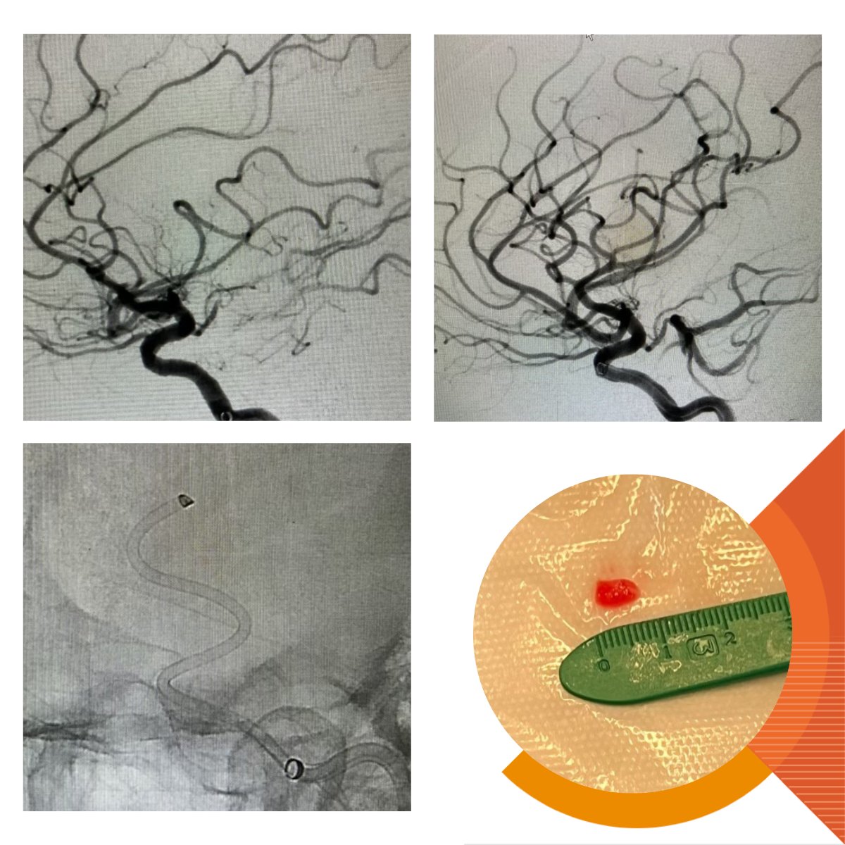ImpCare_Stroke's tweet photo. #Intracranial access with #Zoom88 can provide greater navigational support for your #ZoomAspirationCatheters. Check out this #stroke case from @Dr_Yaeger using #Zoom88, #Zoom55 + #Zoom35. First pass #TICI3 outcome! Thanks for sharing.
@MethodistHosp #ZoomStrokeSolution
Rx Only. ISI: https://t.co/20ZwfceFWm