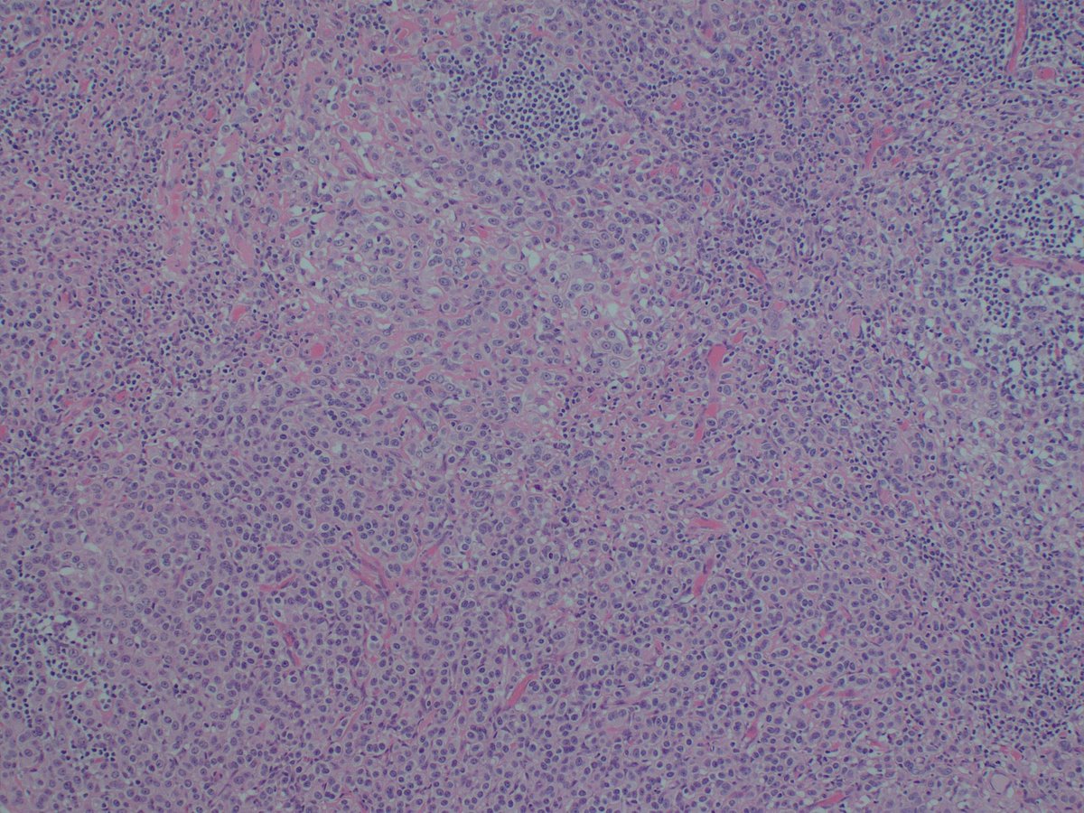 PathRuchi's tweet photo. What is the diagnosis? What history or IHC you would seek?
#pathtwitter #onecaseaday #frcpath https://t.co/ifFSPiWI1n