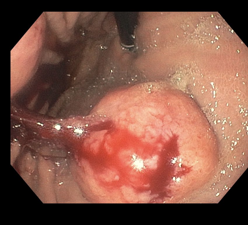 Large, bleeding gastric subepithelial mass w intra luminal extension on EGD for anemia. Subsequent EUS shows hypoechoic, peri-gastric lesion w FNB showing DLBCL.  You never know what you’re going to find on endo -convenient to have EUS nearby! 🤔 #GITwitter