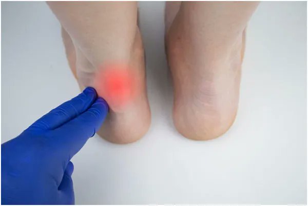 Did you know that the Achilles tendon is the largest tendon in the body? When this tendon becomes inflamed, it can cause significant pain and weakness in your foot and ankle. #BryantHoMD #achillestendonitis #achillestendon #footandankle bryanthomd.com/blog/signs-and…