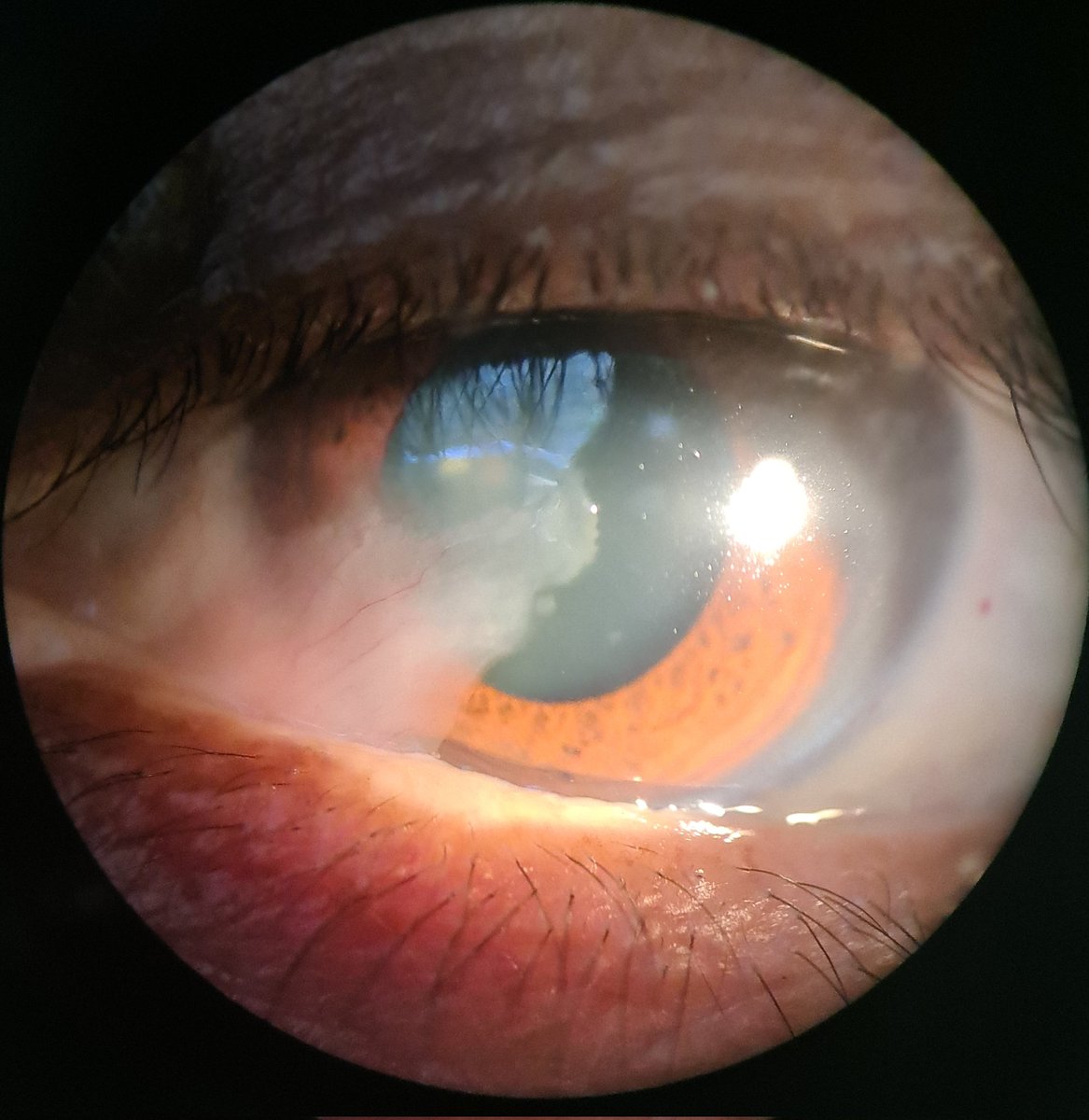 Indicaciones quirúrgicas de pterigión ?? 👁