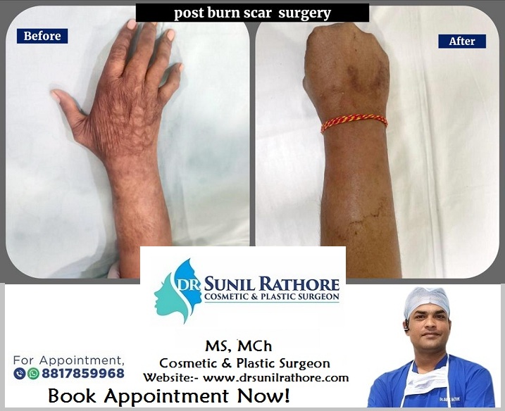 Opt for Cosmetic SURGERY of #BurnScars & Wounds & improve your Appearance!
Consult with one of the Most Trusted & Best cosmetic & Plastic surgeon in Bhopal, MP.
Dr. Sunil Rathore
MS, MCh
Cosmetic & Plastic Surgeon
Contact: +91 88178 59968
Web- drsunilrathore.com
#burnsurgery