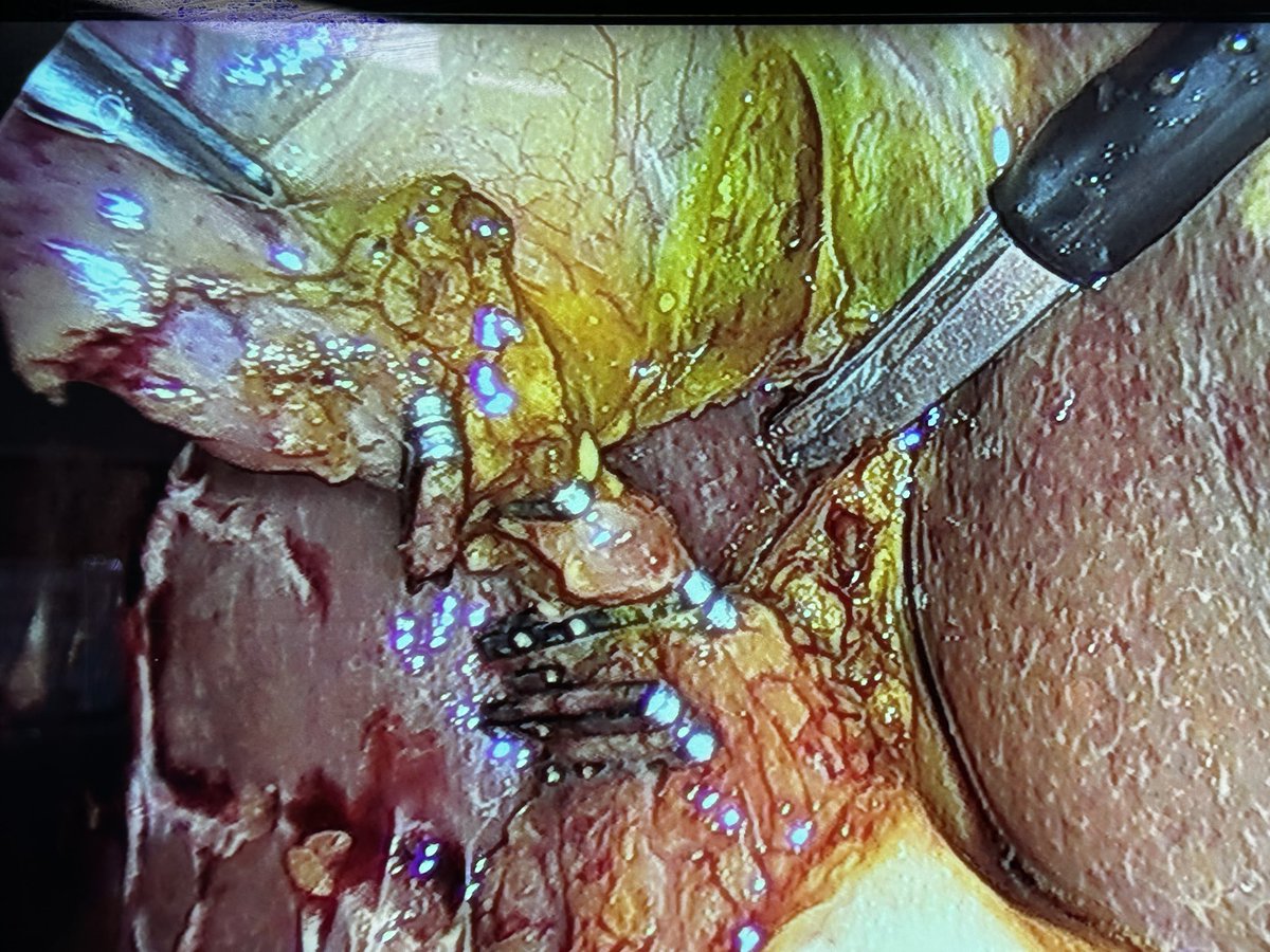 Visión crítica de seguridad en colecistitis de nuestro R1. Desde pequeños adquiriendo buenos hábitos.
<a href="/CirugiaHJRJ/">CirugiaJuanRaHuelva</a> <a href="/aecirujanos/">aecirujanos</a> <a href="/RafaelBalongo/">Rafael BALONGO</a> <a href="/RocioMMojarro/">Rocío M.Mojarro</a> <a href="/RocioPerez_Q/">Rocio Perez Quintero</a> <a href="/g_arboleya/">Rocio M G Arboleya</a> <a href="/aecirujanos/">aecirujanos</a>