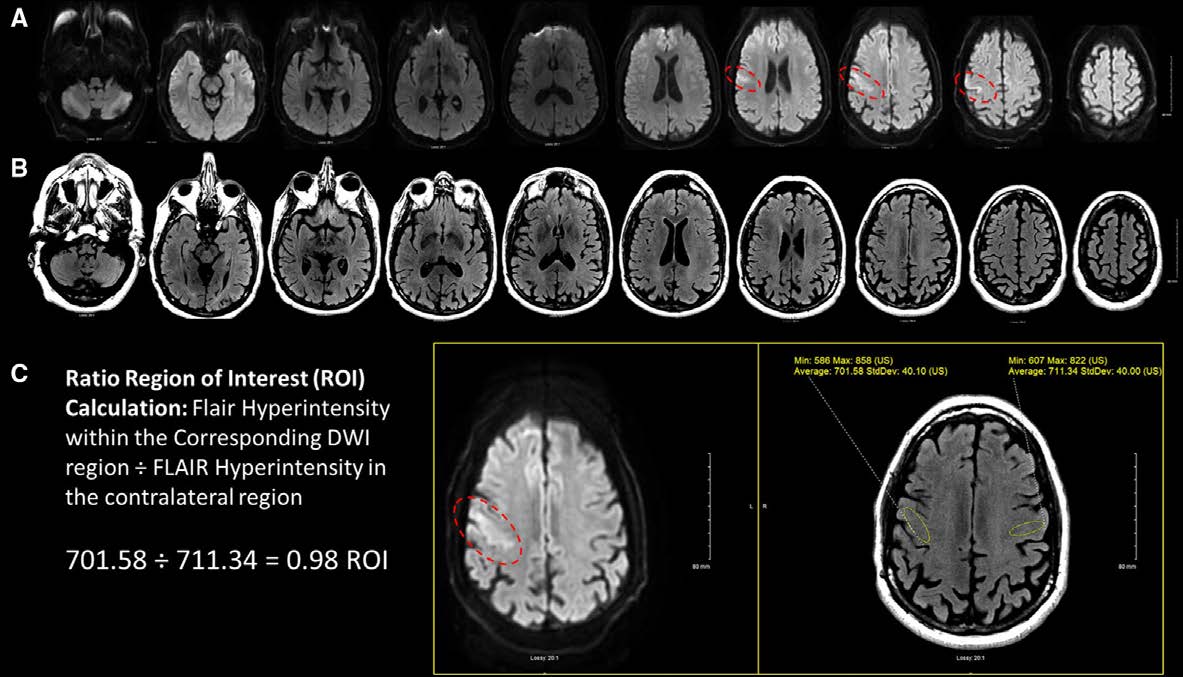 StrokeAHA_ASA's tweet photo. #STROKE Illustrative Teaching Case: Imaging caveats to consider when screening for #Thrombolysis in the extended time window #IVtPA #MRI #CTperfusion https://t.co/F3Iie9kRS5 @dennysreyesMD https://t.co/dvJcF56wSc