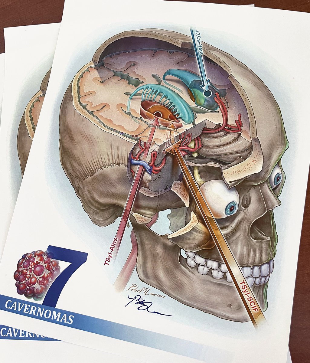 PeterMLawrence1's tweet photo. Come grab a #7Cavernomas print at the @BarrowNeuro 2023 Symposium and say hi👋 @mtlawton https://t.co/Pi3tefEE5W
