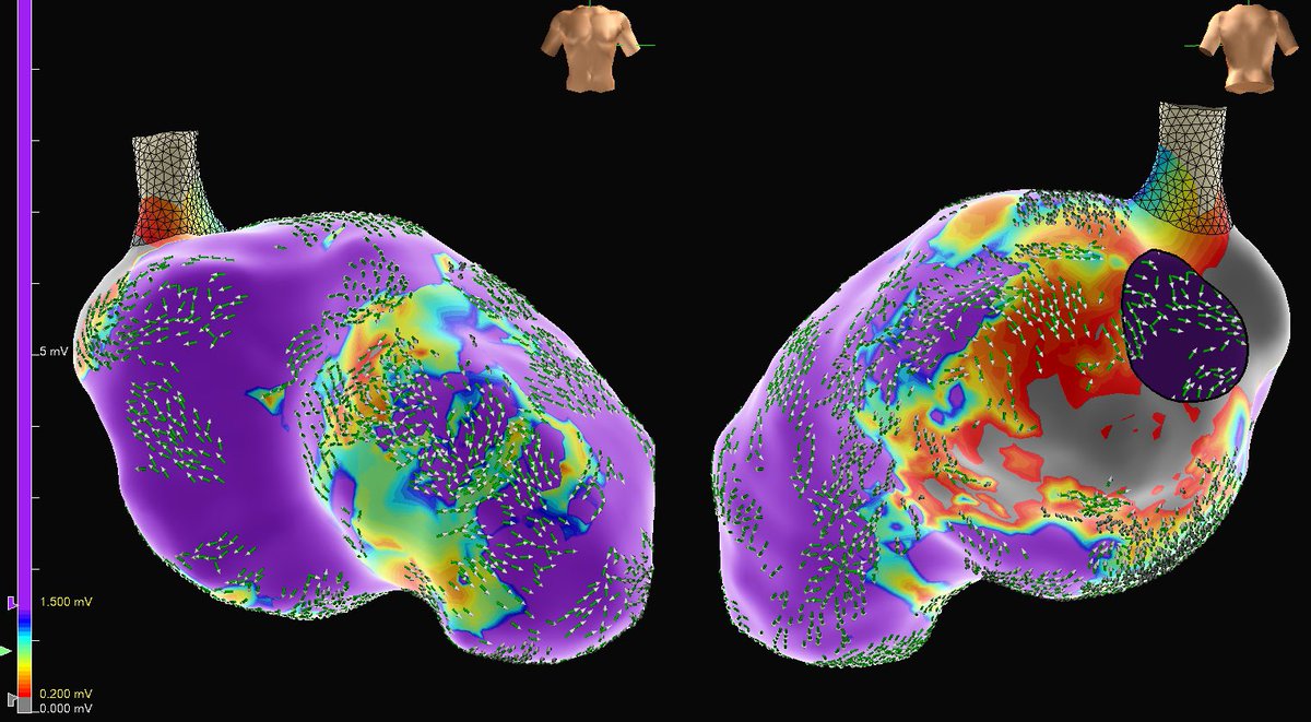 MattMelcherPA's tweet photo. First Isch VT case using OT Near Field. Combo of low voltage &amp; high peak frequency added specificity to substrate/functional map in SR, as well as during VT (like described by @Arritmias_HRC). LV + high PF area co-localized to isthmus of 3 VT’s and lead to 1st burn termination. https://t.co/OENJW48gPU