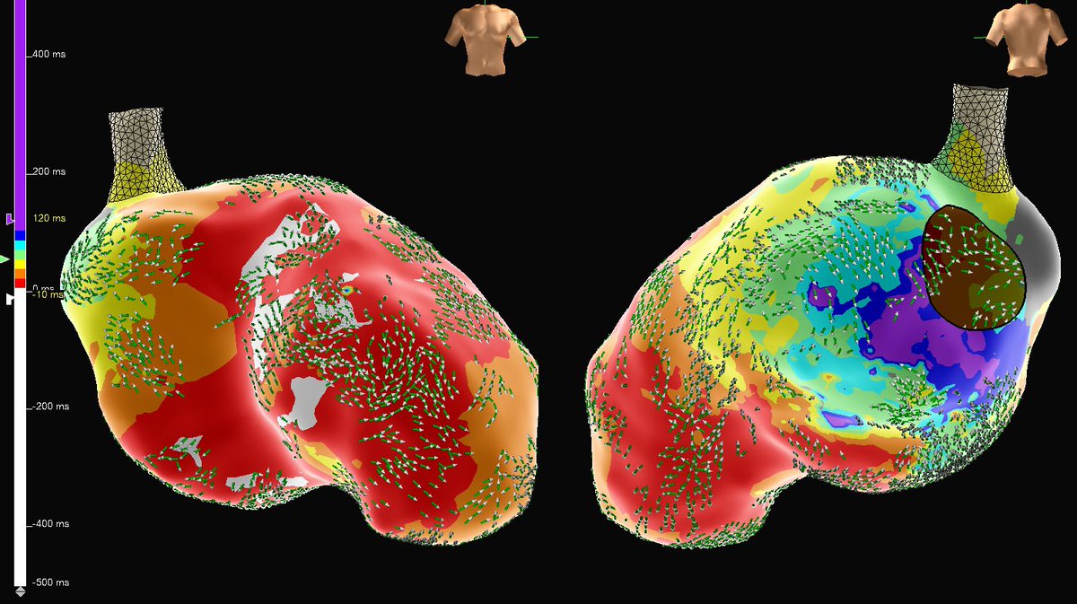 MattMelcherPA's tweet photo. First Isch VT case using OT Near Field. Combo of low voltage &amp; high peak frequency added specificity to substrate/functional map in SR, as well as during VT (like described by @Arritmias_HRC). LV + high PF area co-localized to isthmus of 3 VT’s and lead to 1st burn termination. https://t.co/OENJW48gPU