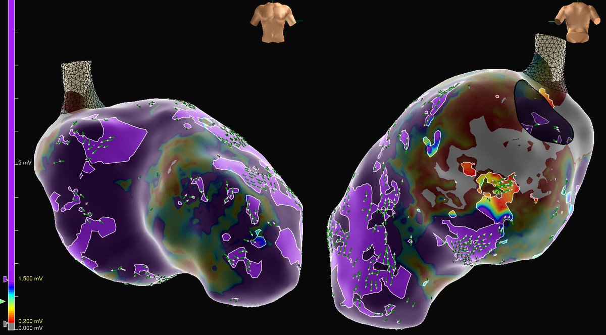 MattMelcherPA's tweet photo. First Isch VT case using OT Near Field. Combo of low voltage &amp; high peak frequency added specificity to substrate/functional map in SR, as well as during VT (like described by @Arritmias_HRC). LV + high PF area co-localized to isthmus of 3 VT’s and lead to 1st burn termination. https://t.co/OENJW48gPU