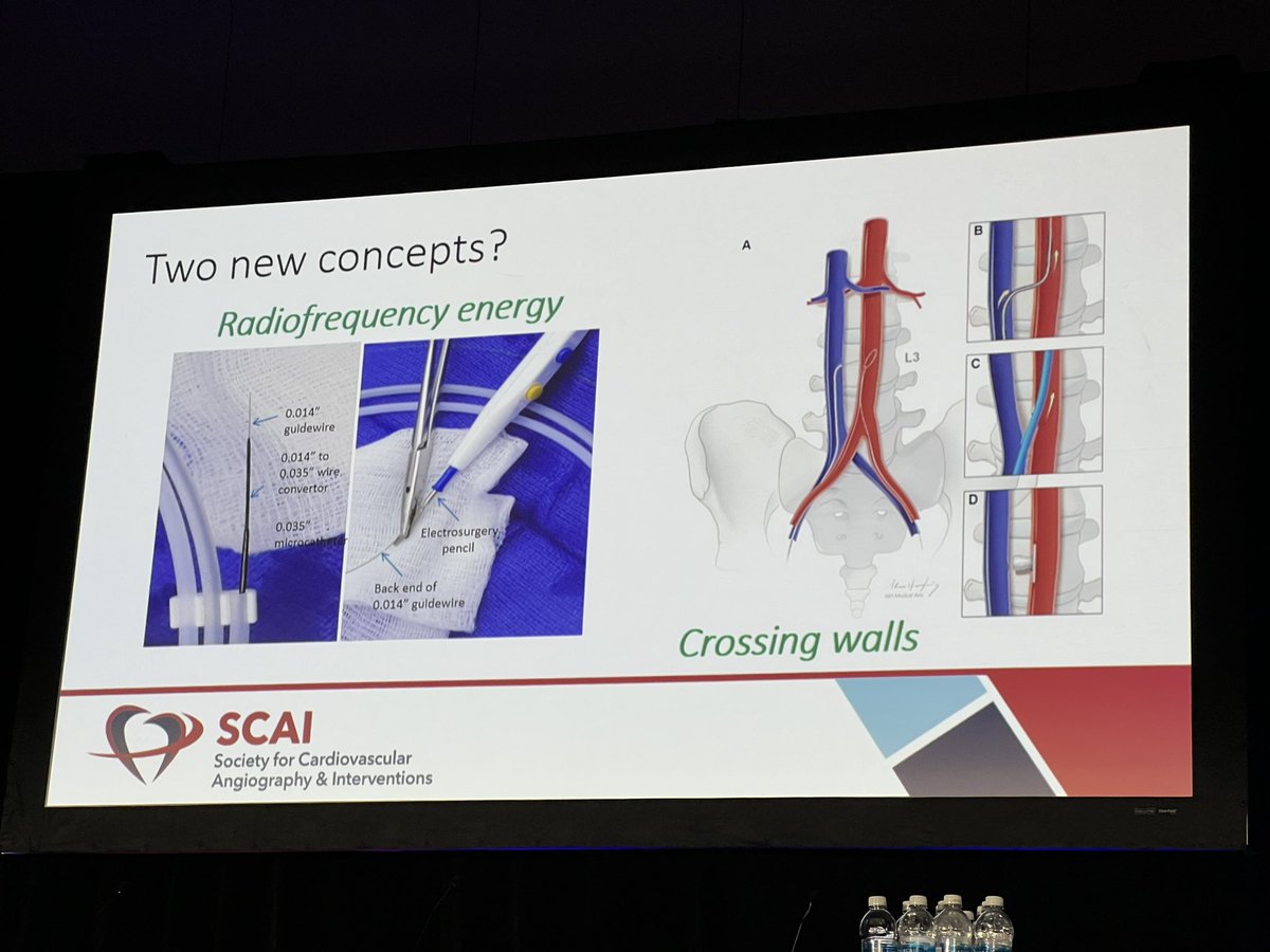 Pooh_Velagapudi's tweet image. Dr. @AdamGreenbaumMD, an innovator in #IC delivers #Hildner lecture discussing several innovative procedures including #transcaval access, and procedures utilizing #electrocautery!! #SCAI2023 @SCAI @scaiwin #innovation